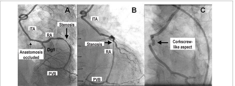 Technical difficulty in stenting Supralimus in radial artery graft