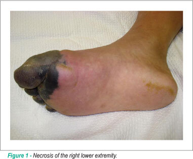 Marantic endocarditis and adenocarcinoma of unknown primary site