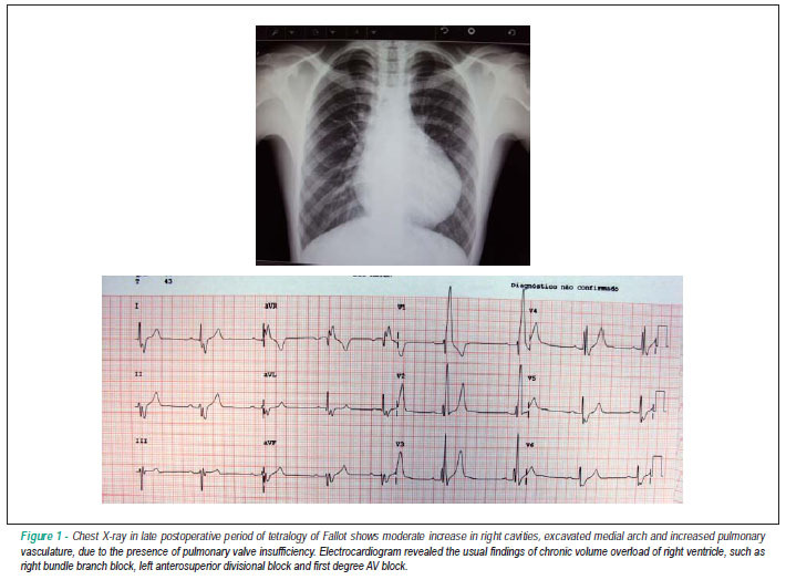 Case 3/2011: 17-year-old male adolescent with accentuated pulmonary insufficiency as a residual lesion by prior correction of tetralogy of Fallot performed 14 years ago