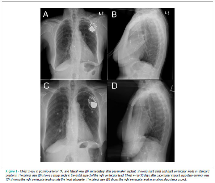 Right ventricular perforation by a passive-fixation pacemaker lead