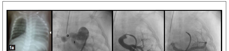 Pulmonary hypertension in infants linked to horseshoe lung: case report