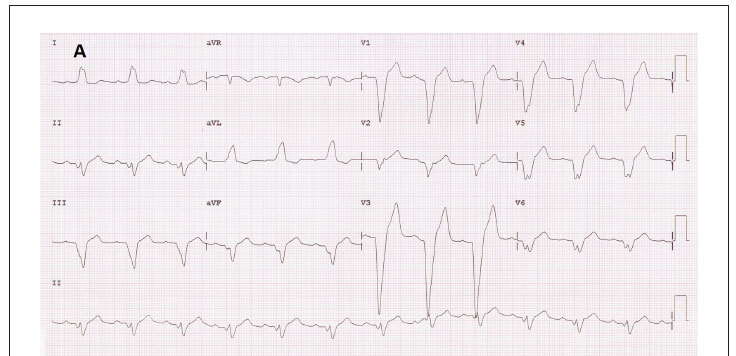 "Hyper-response" evaluated by 3D echocardiography after cardiac resynchronization therapy