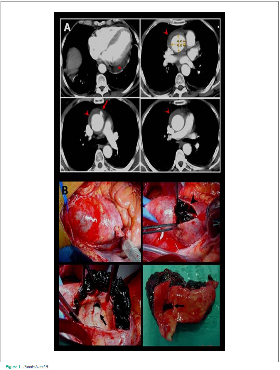 Penetrating atherosclerotic ulcer involving the ascending aorta