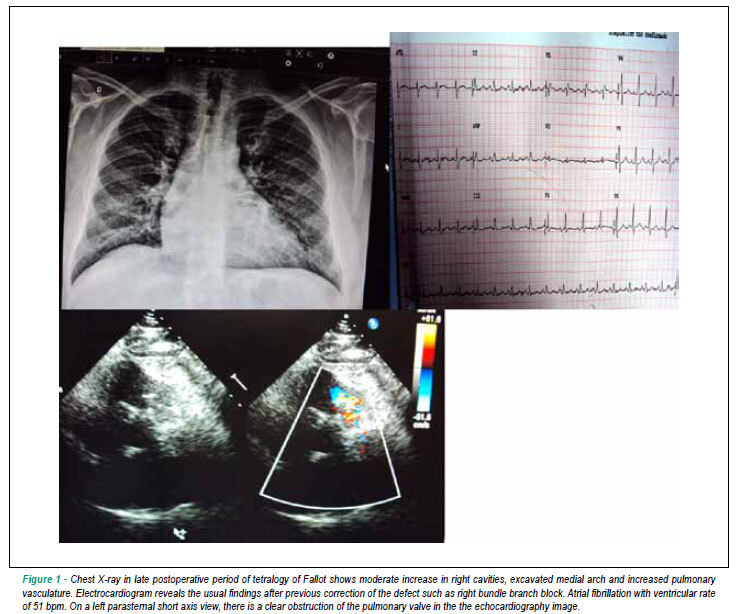 Case 4/2011 - 49-year-old man with pulmonary valve stenosis and atrial septal defect as residual lesions after correction of tetralogy of Fallot, which occurred 30 years ago