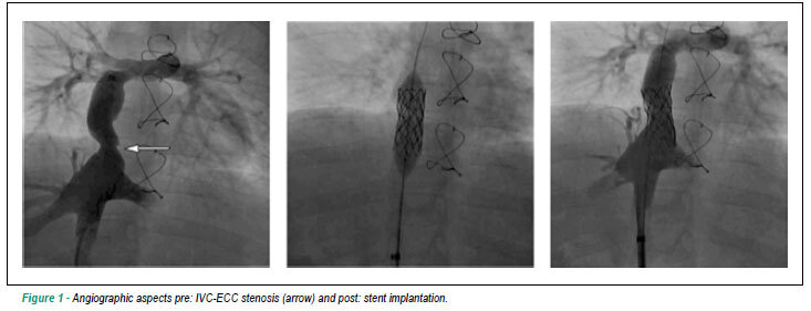 Stent implantation in surgical cavopulmonary conduit: report of two cases