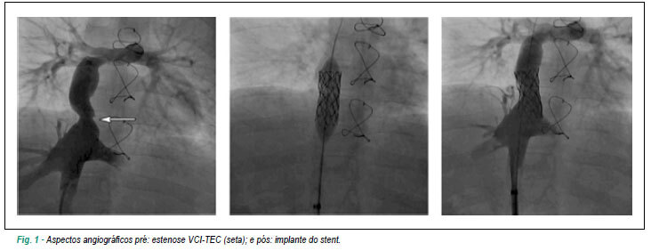 Implante de stents em conduto cirúrgico cavopulmonar: relato de dois casos