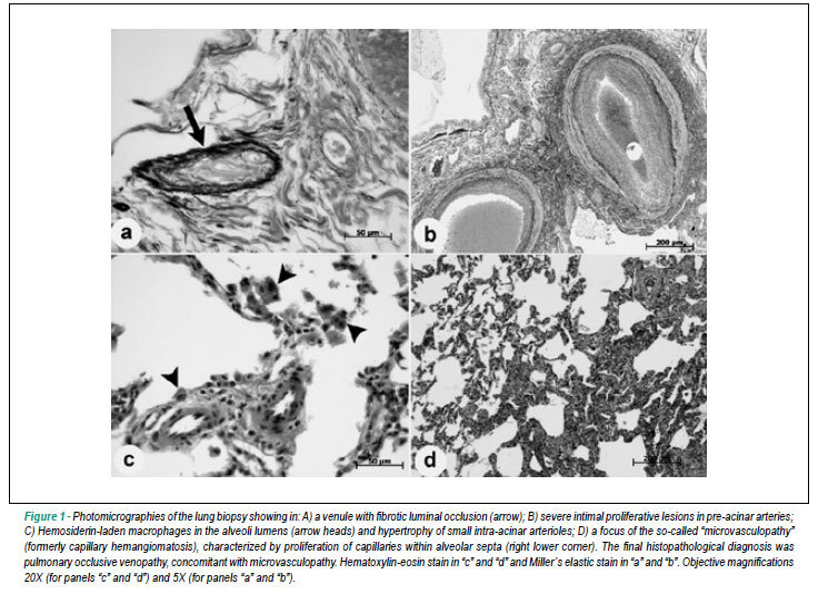 Occlusive venopathy phenotype in hereditary pulmonary arterial hypertension