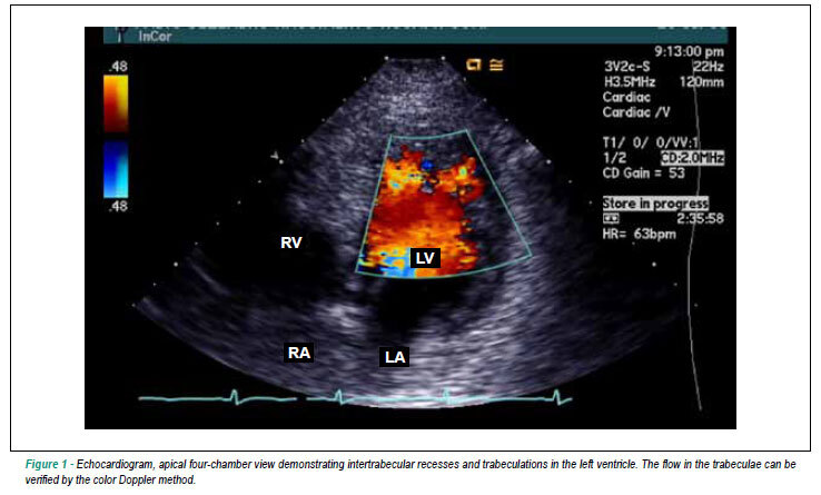 Noncompaction cardiomyopathy: a current view