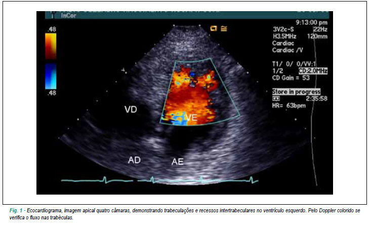 Miocardiopatia não compactada: uma visão atual