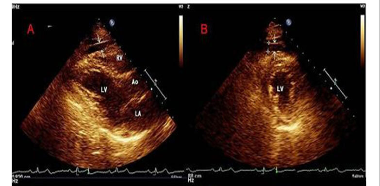 Echocardiographic parameters of epicardial fat deposition and its relation to coronary artery disease