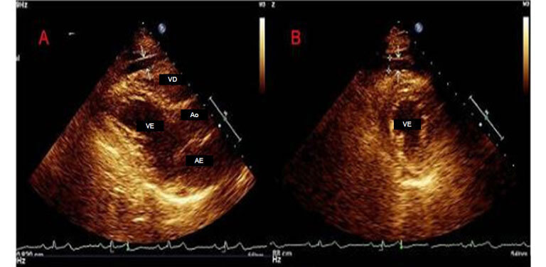 Parâmetros ecocardiográficos de deposição de gordura epicárdica e sua relação com doença arterial coronariana