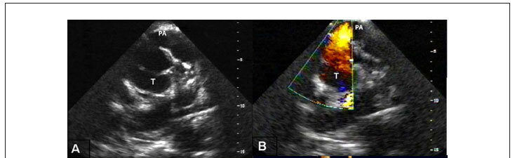 Atypical truncus arteriosus operated at 28 years of age: importance of differential diagnosis