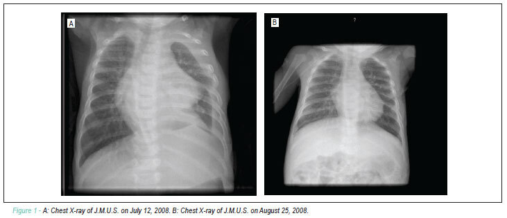 Use of octreotide in the treatment of chylothorax and chyloperitoneum