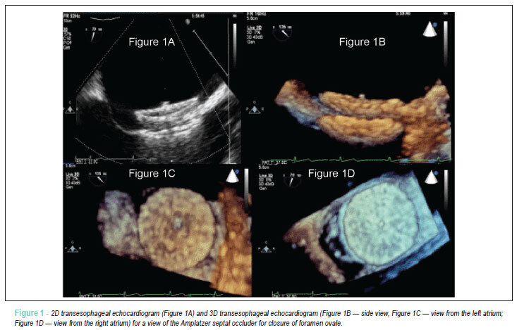 Amplatzer septal occluder for closing foramen ovale: view through 3D echocardiography