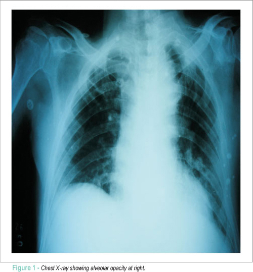 Austrian Syndrome: case report