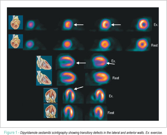 Treatment of left main coronary artery lesion after late thoracic radiotherapy