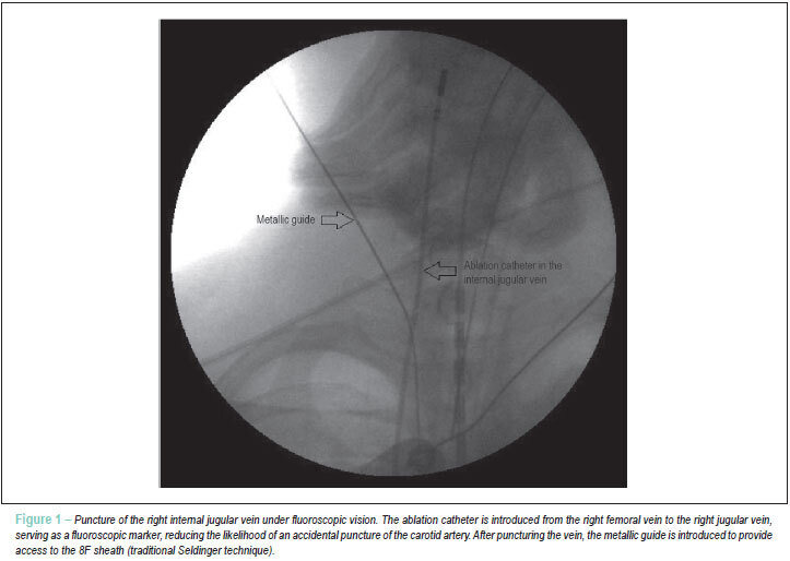 Safety of ablation for atrial fibrillation with therapeutic INR: comparison with transition to low-molecular-weight heparin