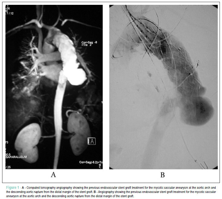 Aorta after stent grafting for mycotic aneurysm