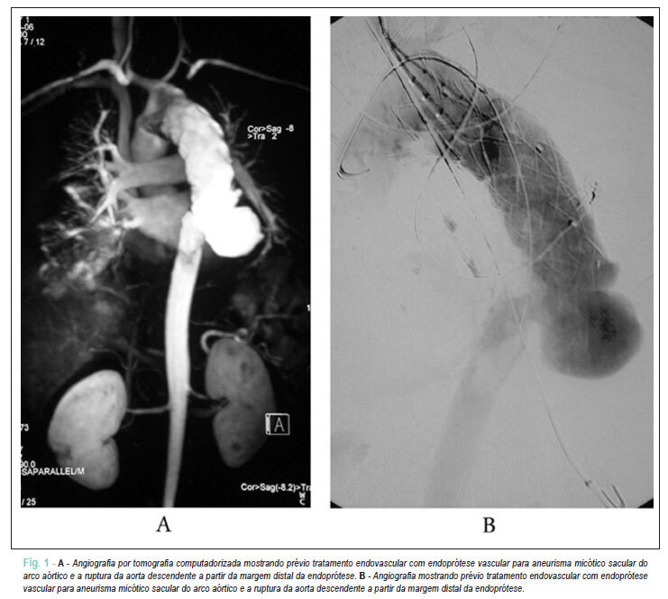 Aorta após endoprótese para aneurisma micótico
