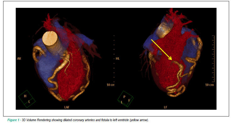 Coronary fistula to the left ventricle: assessed by computed tomography