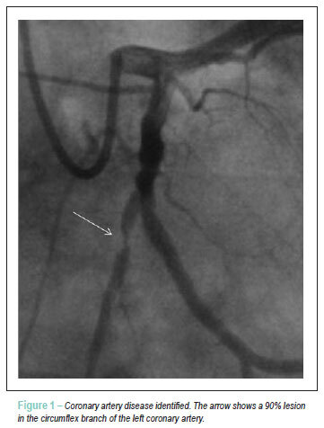 Asymptomatic coronary artery disease in chagasic patients