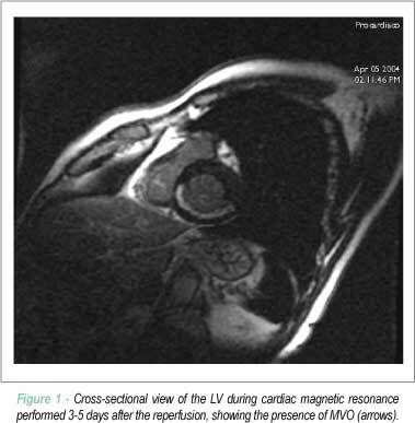 Intracoronary stem-cell injection after myocardial infarction: microcirculation sub-study