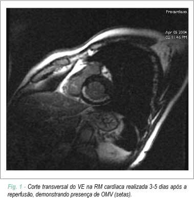 Injeção intracoronariana de células tronco após infarto do miocárdio: subestudo da microcirculação