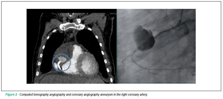 Mycotic coronary aneurysm: report of two cases