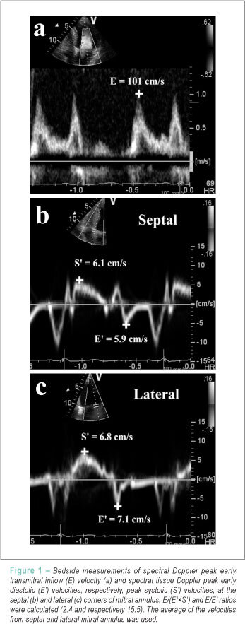 A new tissue doppler index in predicting future atrial fibrillation in patients with heart failure