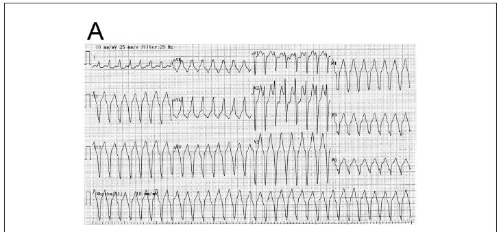 Ventricular tachycardia associated with non-Hodgkin's lymphoma
