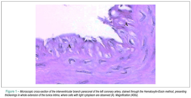 Myocardial bridge associated with cardiovascular injuries in bovines adult of Canchim race