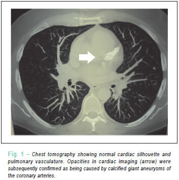 Case 1/2012: 55-year-old male with multiple coronary artery aneurysms due to Kawasaki disease