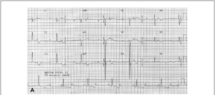 Atrioventricular block pathology in cardiomyopathy by desmin deposition