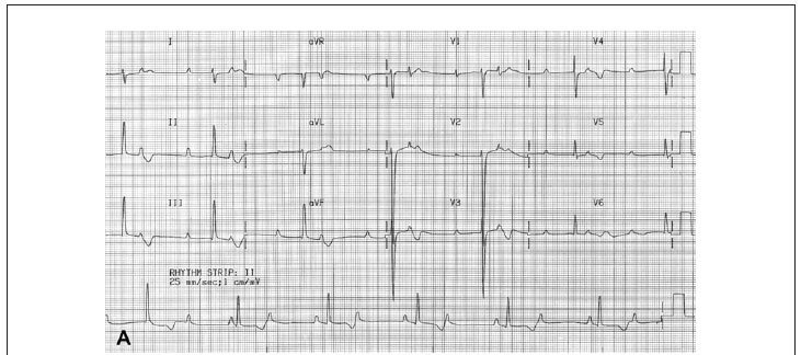 Patologia do bloqueio atrioventricular na cardiomiopatia por depósito de desmina