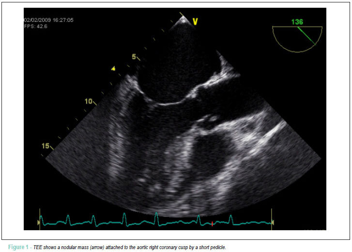 Recurrent myocardial infarction in a patient with papillary fibroelastoma