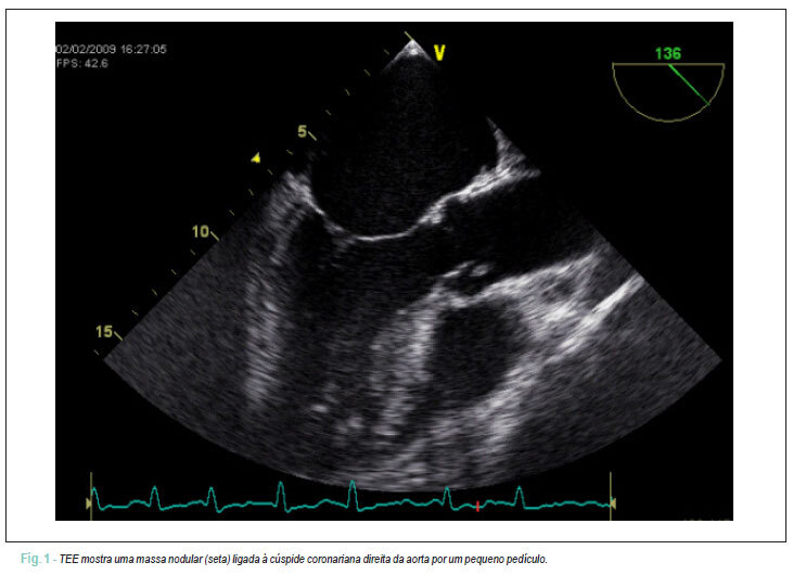 Infarto do miocárdio recorrente em um paciente com fibroelastoma papilar