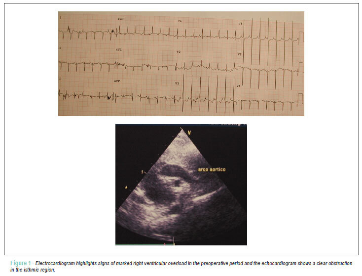 Case 2/2012: eleven-day-old infant with marked coarctation of the aorta in cardiogenic shock