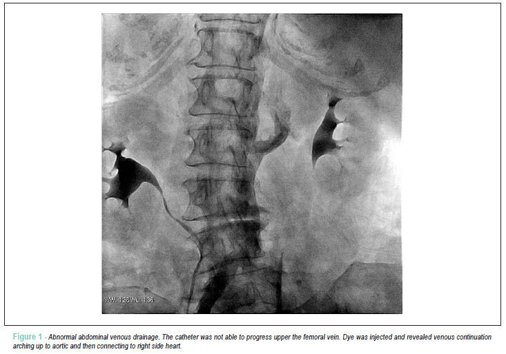 Cardiovascular magnetic resonance in unsuspected interrupted inferior vena cava