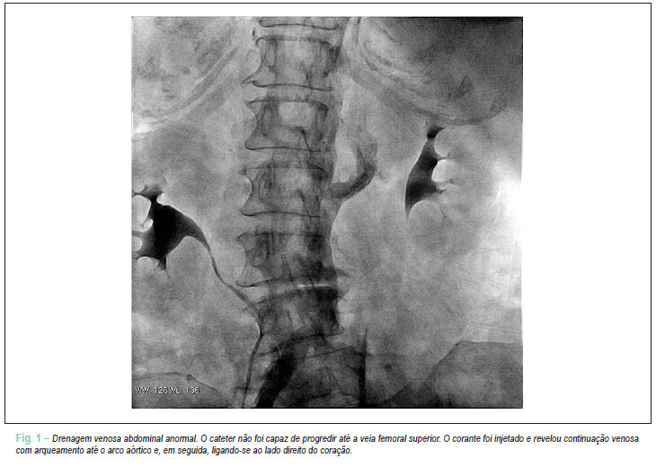 Ressonância magnética cardiovascular em veia cava inferior interrompida não prevista