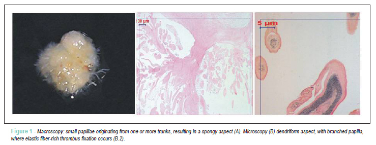 Papillary fibroelastoma: report of seven cases