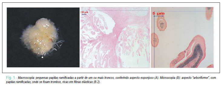 Fibroelastoma papilífero: relato de sete casos