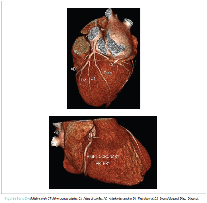Multislice coronary angiotomography in the assessment of coronary artery anomalous origin