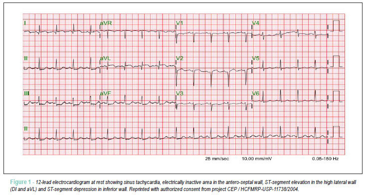 Coronary thrombosis as the first complication of antiphospholipid syndrome