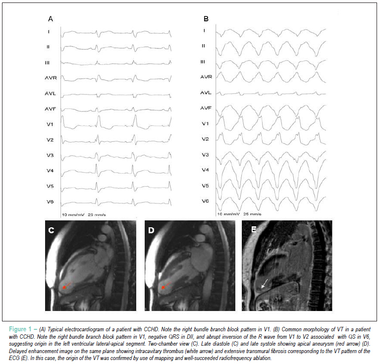 Delayed enhancement cardiac magnetic resonance Imaging can identify the risk for ventricular tachycardia in chronic Chagas' heart disease
