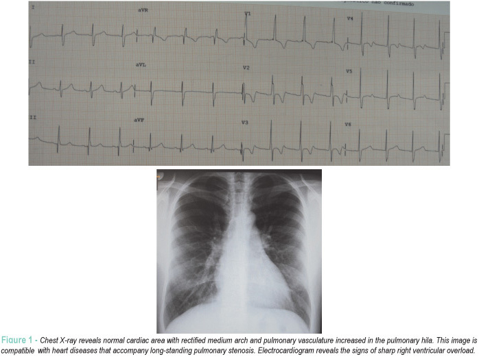 Case 4/2012: 25-year-old man with obstructive fibroma in right ventricular outflow tract