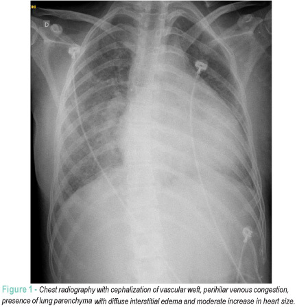 Rare manifestation of acute pulmonary edema associated with acute lupus myocarditis