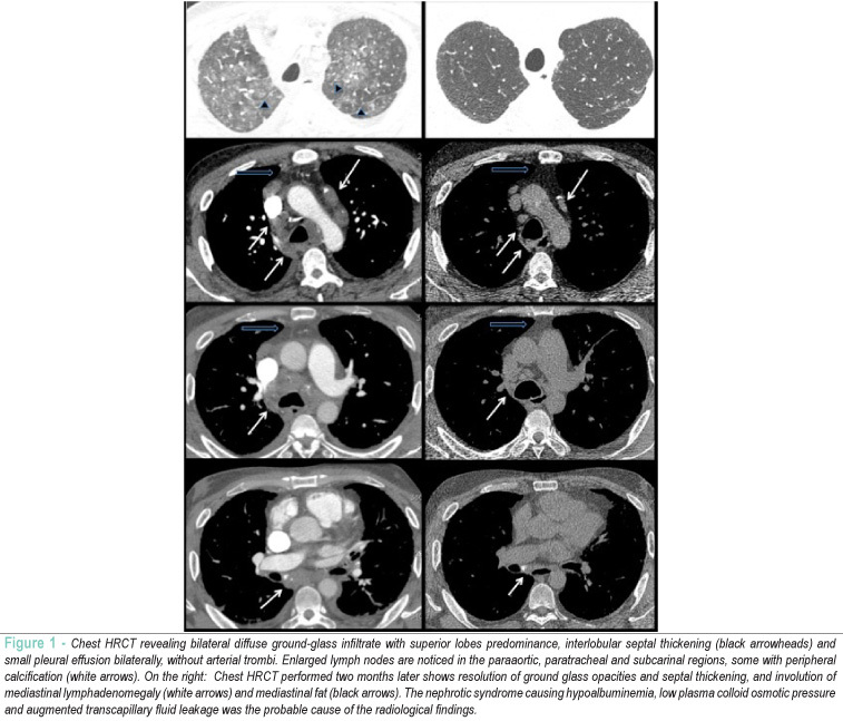 Transient lymphadenopathy secondary to nephrotic syndrome