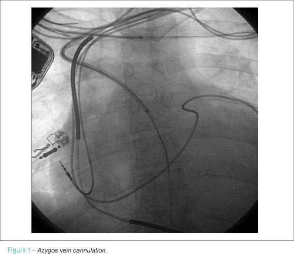 Azygos vein lead implantation: a therapeutic option for elevated defibrillation threshold