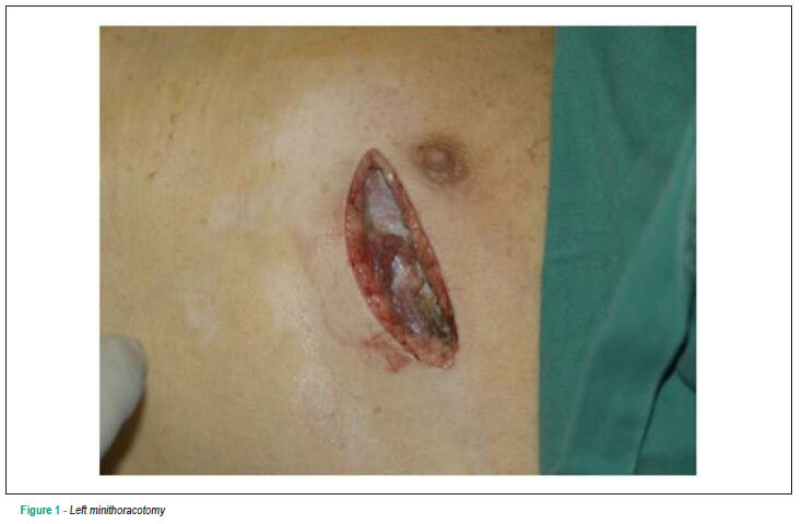 Minimally-invasive video-assisted coronary-artery bypass grafting