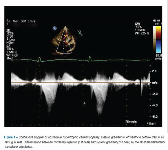 The diagnosis of left ventricular outflow tract obstruction in hypertrophic cardiomyopathy